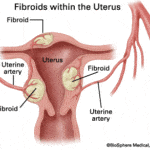 FAQ: Uterine fibroids and fertility