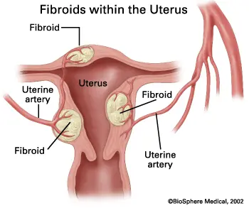 Fertility Facts: Fibroids and Fertility