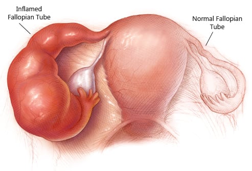 Pelvic inflammatory disease (PID) Gone after using Shisheherbal PID full  one month treatment This is indeed a beautiful way to start the…